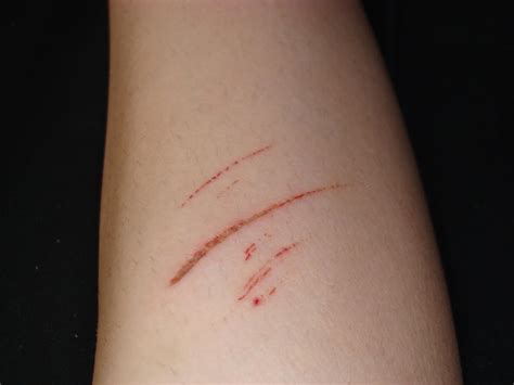 The Cut On My Leg By Nejihyuga73 On Deviantart