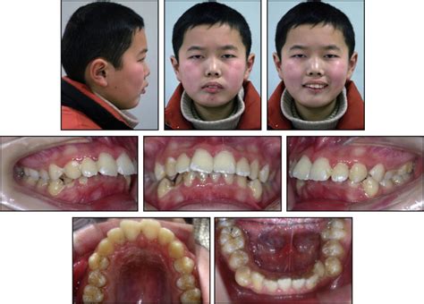 Two Phase Treatment Of Skeletal Class Ii Malocclusion With The