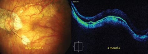 A Fundus Photograph Of A Highly Myopic Eye With Central Macular