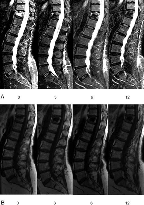 Pdf Osteoporotic Vertebral Compression Fractures And Vertebral Images