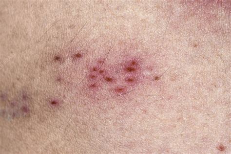 Healing Shingles Rash Stock Image C0478497 Science Photo Library