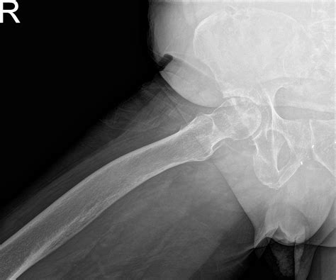 Case Study Right Total Hip Replacement In 75 Year Old Female Ny Usa