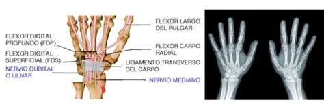 Lesión Fibrocartílago Triangular O Fct Meds