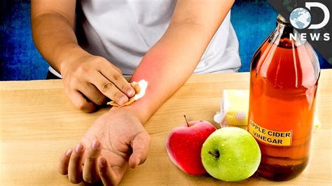 Can Apple Cider Vinegar Get Rid Of A Cyst All Answers