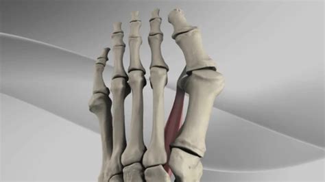 Arthrex First Metatarsal Phalangeal Joint Fusion With Lapidus Plate