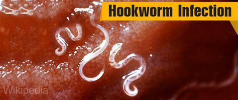 Hookworm Infection Causes Symptoms Diagnosis Treatment And Prevention