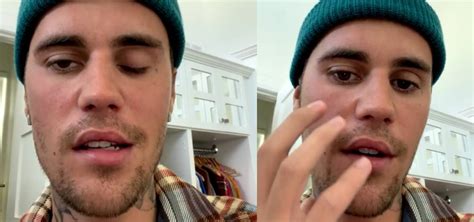 Important Watch It Justin Bieber Suffering From Partial Face Paralysis