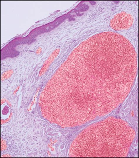 Rituximab For Low Grade Follicular Lymphoma The Lancet Oncology