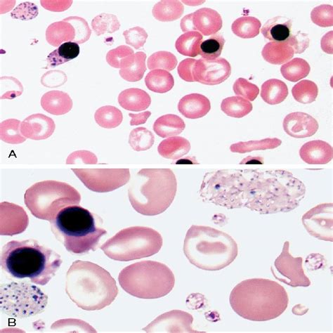 Thalassemias Rodaks Hematology Clinical Principles And Applications