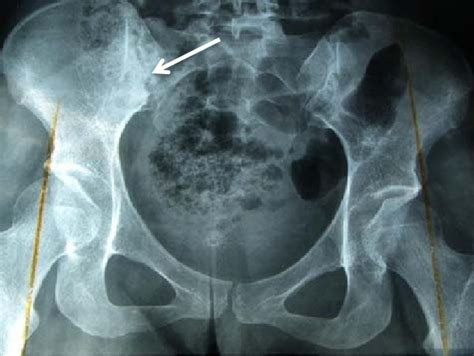 Radiography Of Sacroiliac Joint Ferguson View Showing Right
