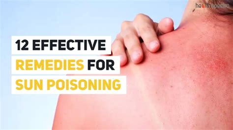 12 Effective Remedies For Sun Poisoning Healthspectra Youtube