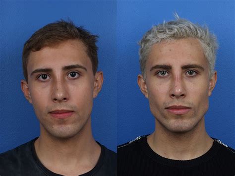 Jaw Fillers Before And After Male Before And After