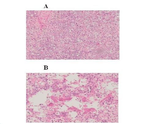 Histologic Assessment Of Post Mortem Lung Tissue Lung Sections Were
