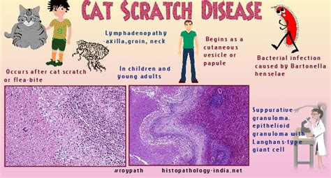 Pathology Of Cat Scratch Disease Dr Sampurna Roy Md
