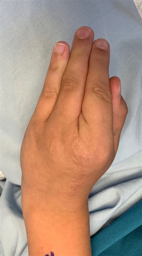 Cleft Hand Beyond The Basics Congenital Hand And Arm Differences