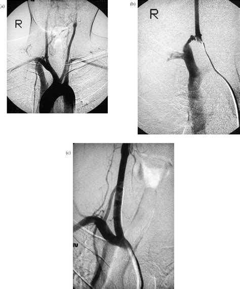 Figure 1 From Endovascular Treatment Of Penetrating Thoracic Outlet