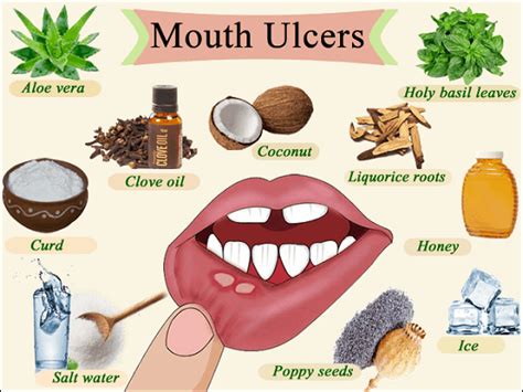 Mouth Ulcers Sabka Dentist Top Dental Clinic Chain In India Best Dentists Near Me