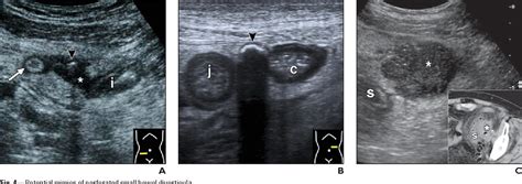 Figure 4 From Sonography Of Small Bowel Perforation Semantic Scholar