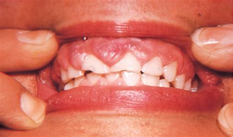 Review Differential Diagnosis Of Drug Induced Gingival Hyperplasia And