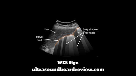 Wes Ultrasound Sign Youtube