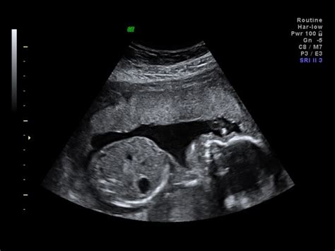 Private Anomaly Scans In The Uk Ultrasound Plus