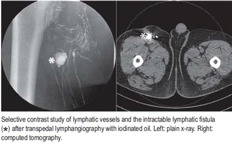 Intractable Postoperative Lymphatic Fistula With Impaired Wound Healing