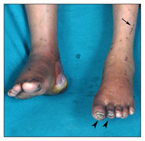 Image Diagnosis Bullosis Diabeticorum The Permanente Journal