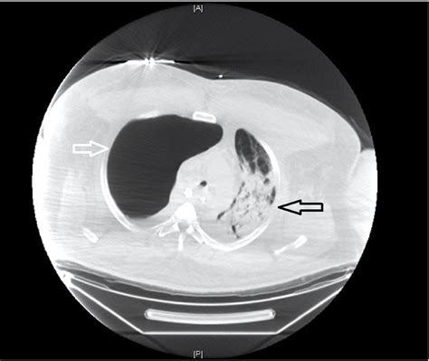 Cureus Vanishing Lung Syndrome Compound Effect Of Tobacco And