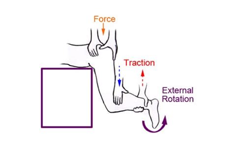 Best Practices Effective Reduction Techniques For Lower Extremity