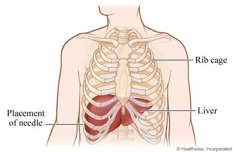 Pain under the left rib cage can mean anything from a ruptured spleen, to heart trouble, to just needing to have a good fart. Placement of Liver Biopsy Needle