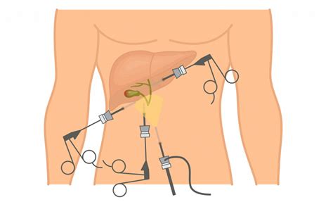 Laparoscopic Cholecystectomy Benefits Contraindications Procedure Care Recovery And
