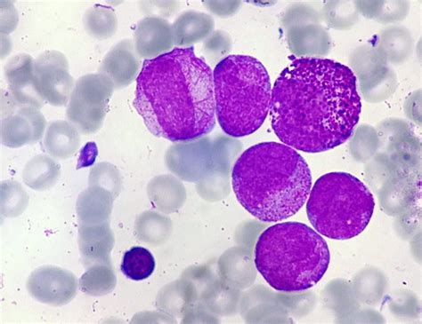 Leucemia Promielocitica Aguda Pdf