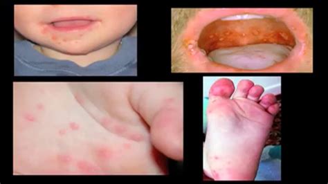 Stlmoms Hand Foot And Mouth Disease Fox 2