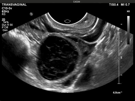 Aspecto Ultrassonogr Fico Dos Cistos Hemorr Gicos Ovarianos Dr Pixel