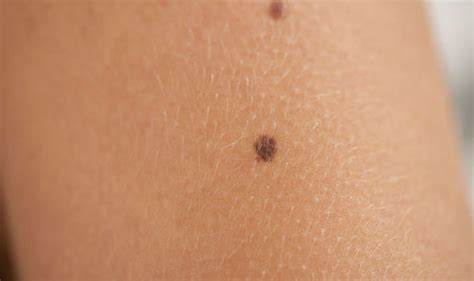 How Deadly Is Melanoma Skin Cancer Cancerwalls
