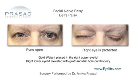 Eyelifts New York Dr Amiya Prasad Facial Paralysis