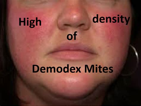 According To National Rosacea Society While Demodex Folliculorum Are