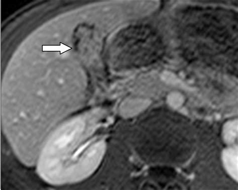 Uncommon Intraluminal Tumors Of The Gallbladder And Biliary Tract