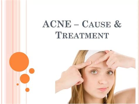 Ppt Acne Cause And Treatment Powerpoint Presentation Free Download