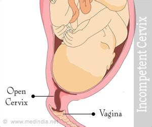 Incompetent Cervix Cervical Insufficiency Causes Symptoms