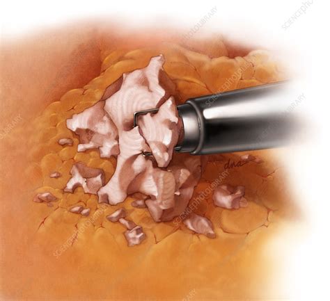 Morcellation Of Uterine Fibroids Stock Image C044 0369 Science Photo Library