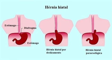 hérnia de hiato causas sintomas e refluxo
