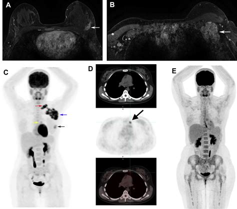 PET Imaging For Breast Cancer Radiology Key