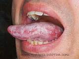 Pictures of Home Remedies Yeast Infection Mouth