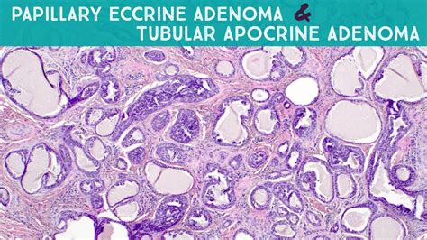 Papillary Eccrine Adenoma Tubular Apocrine Adenoma Dermpath In 5
