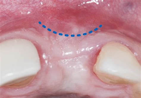 Palate Free Treatment For Gum Recession And Tissue Loss