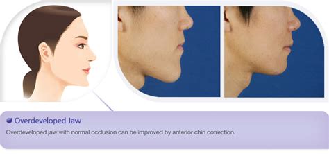 Bk Plastic Surgery Bk Plastic Surgery Protruding Chin Correction