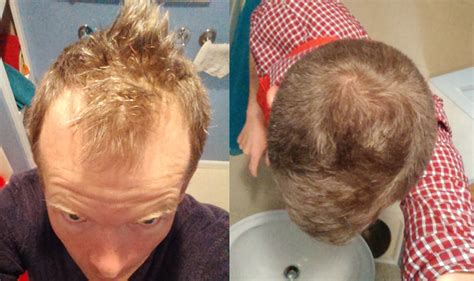 Admin december 29, 2017 hair loss no comments. How I Thickened My Hair and Advanced My Hairline with a ...