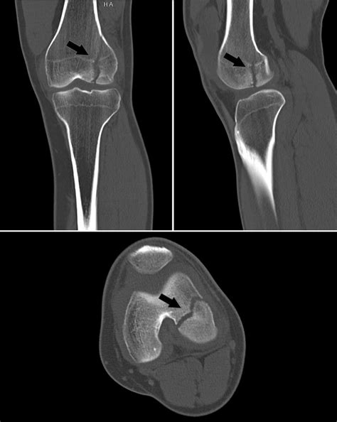 Noncontrast Ct Of The Left Lower Extremity Download Scientific Diagram
