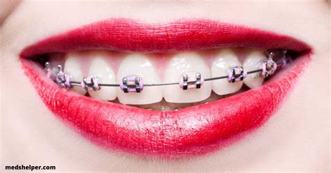 Should You Get Purple Braces On Teeth Meds Helper